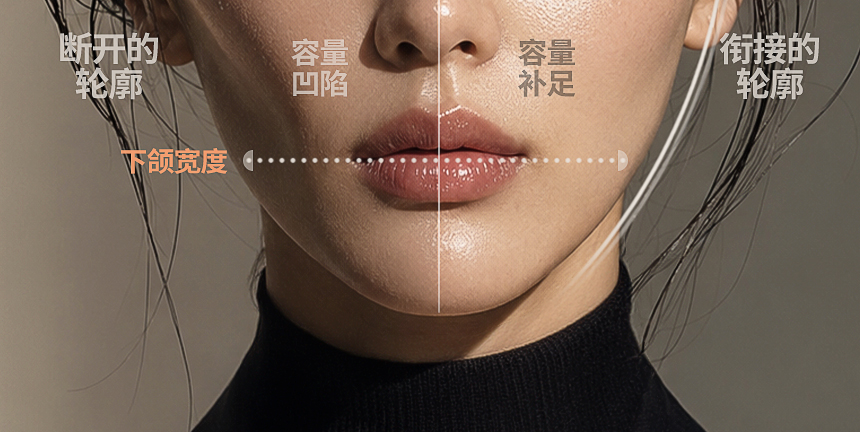 侧颊与下巴脸型设计案例