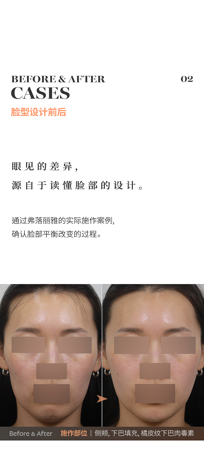 额头太阳穴下巴填充与咬肌肉毒素案例