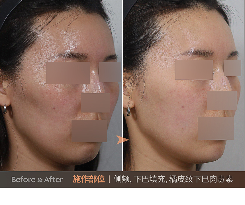 下颊提升激光脸型设计案例