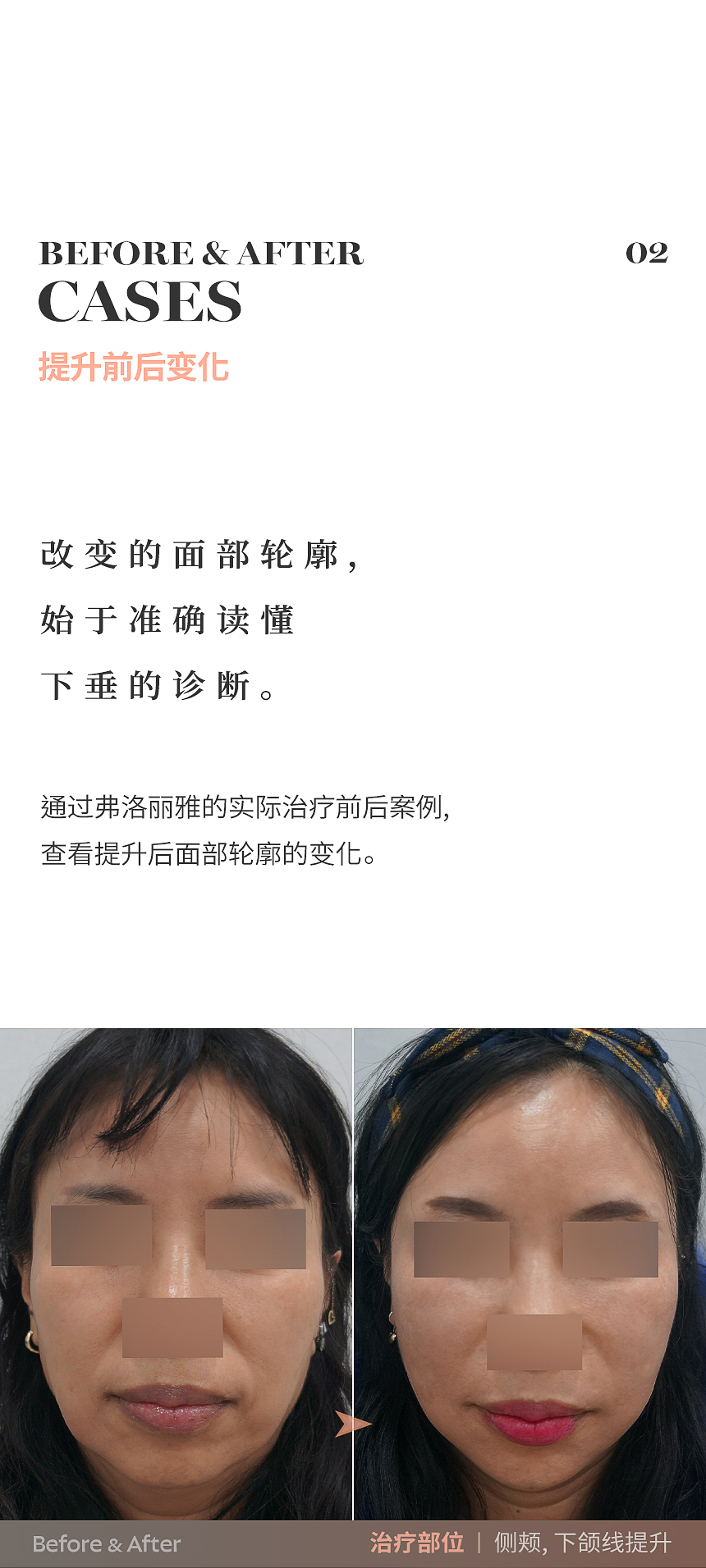 02_ 脂肪层 & 下半脸变化