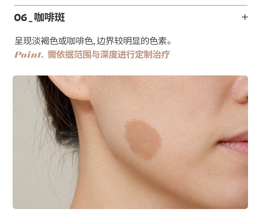 色斑·雀斑色素激光治疗