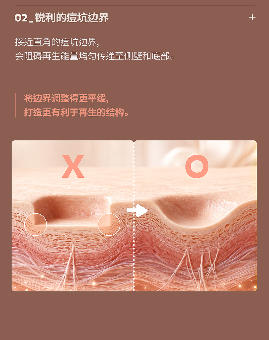 痘坑锐利边界修整与真皮再生