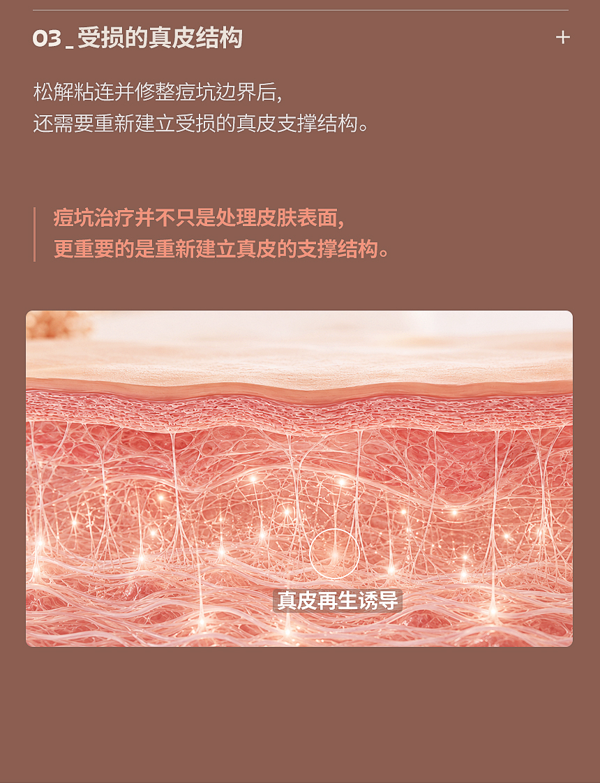 痘坑受损真皮结构再生治疗