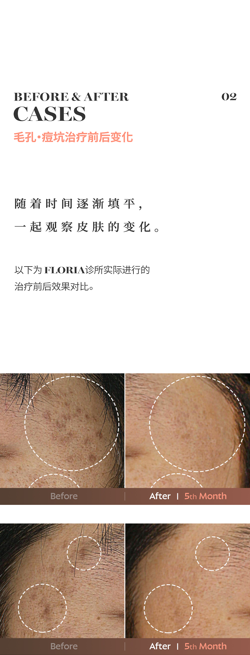 FLORIA 毛孔·痘坑治疗前后案例