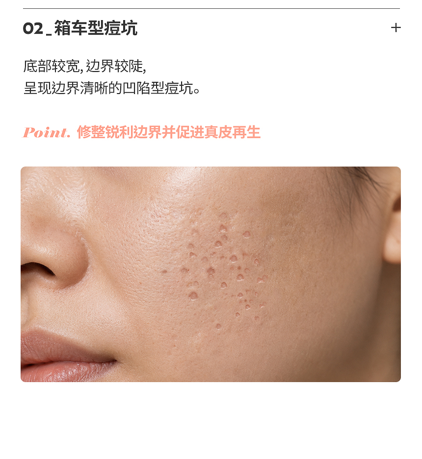 滚动型痘坑凹陷治疗