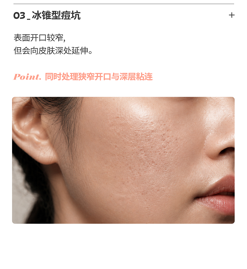 箱车型痘坑边界与凹陷治疗