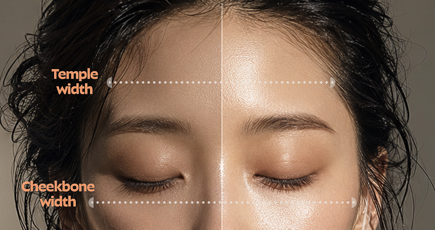 Lateral cheek chin filler and pebble-chin Botox case