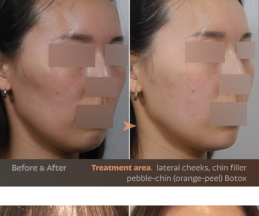 Lower-cheek lifting laser case