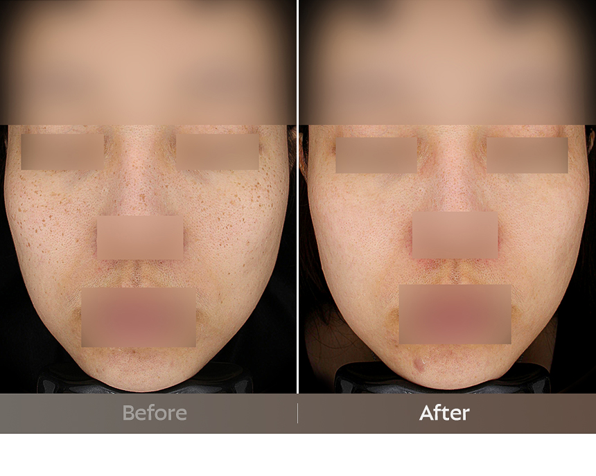 Busan FLORIA Clinic pigmentation treatment