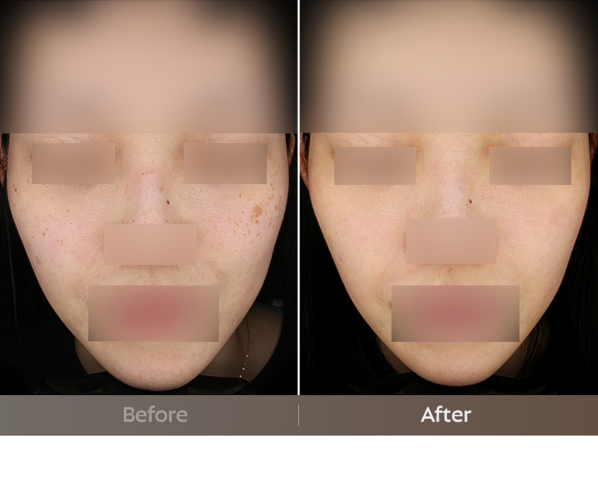 Busan FLORIA Clinic pigmentation treatment