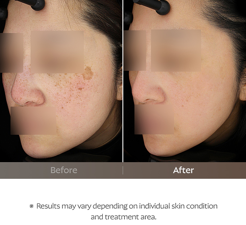 Busan FLORIA Clinic pigmentation treatment