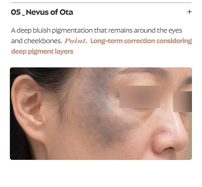 Busan FLORIA Clinic pigmentation treatment