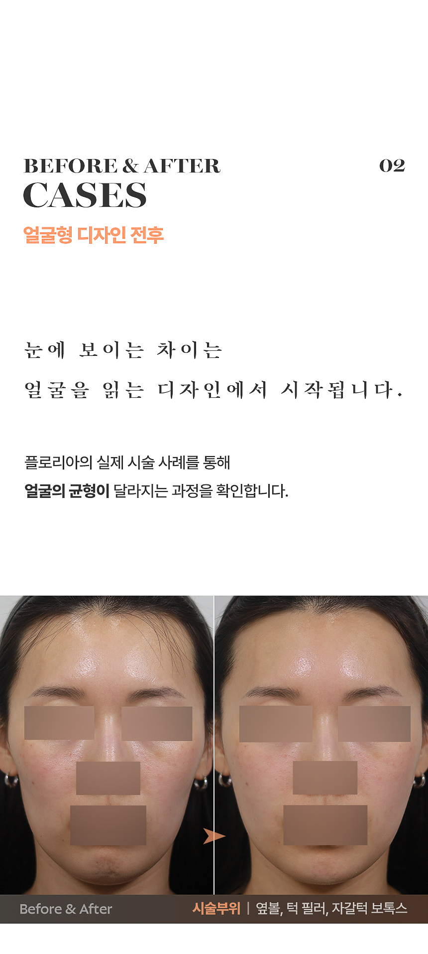 얼굴형 디자인 시술 예시