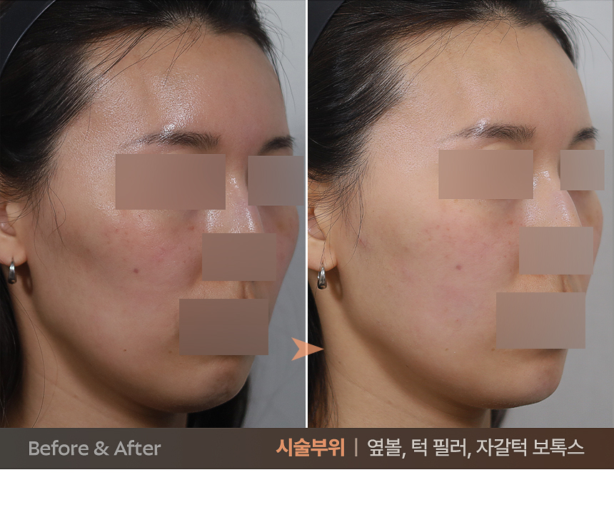 페이스라인 디자인 예시
