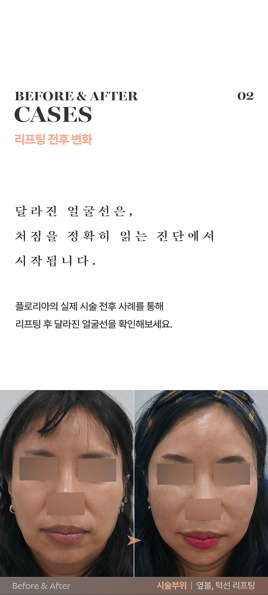 써마지 고주파 리프팅