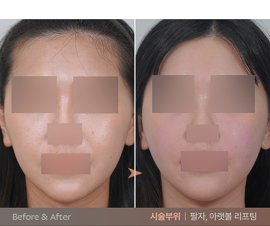 써마지 피부 탄력 타이트닝