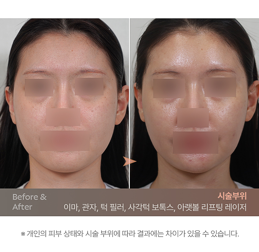 인모드 얼굴 윤곽 피부 탄력 리프팅