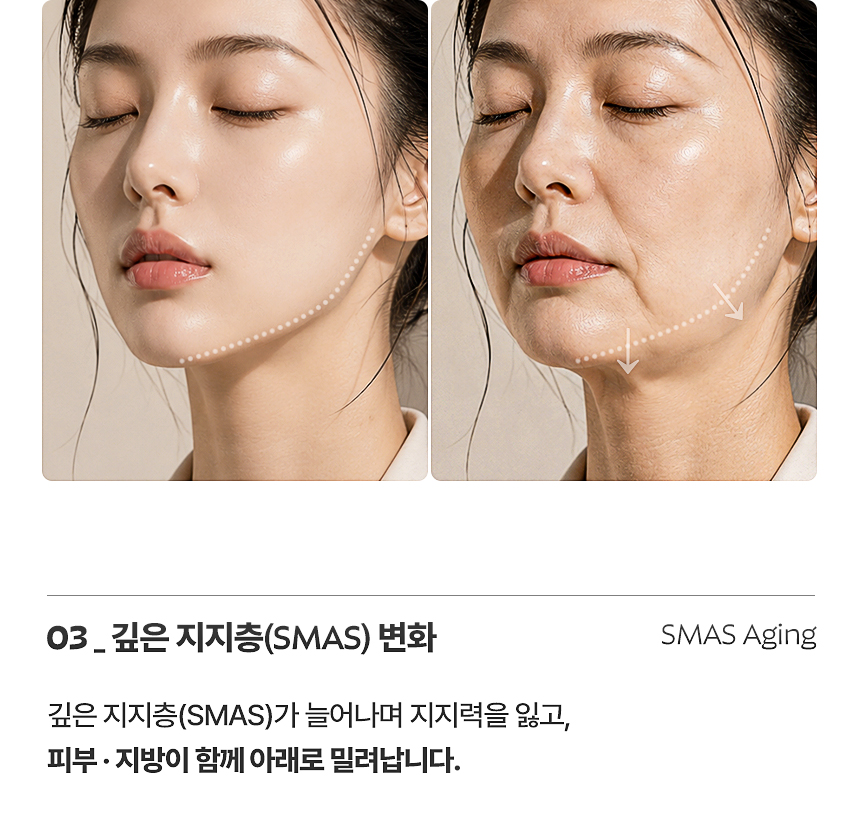 플로리아 소프웨이브 온다 리프팅
