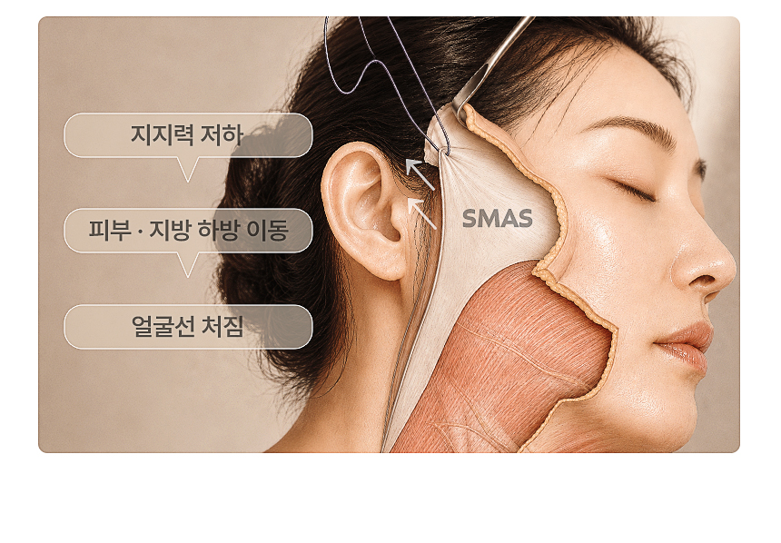 소프웨이브 초음파 리프팅