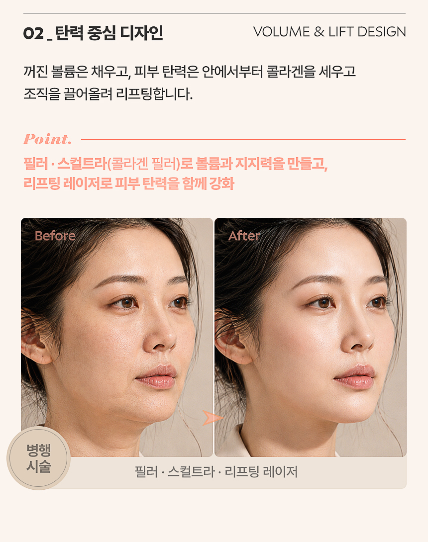 피부 두께와 처짐 정도에 따른 리프팅