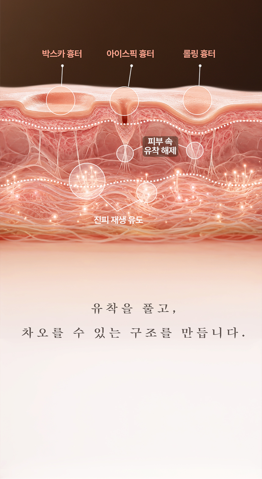 여드름 흉터 유착 해제와 진피 재생 치료