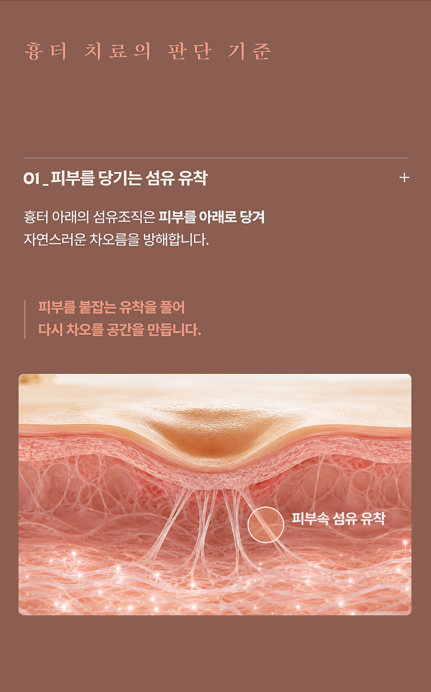 패인 여드름 흉터 피부 속 섬유 유착 치료