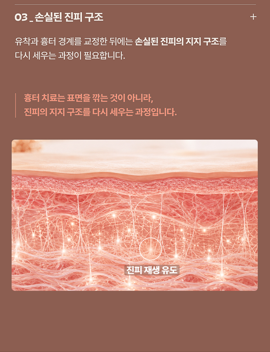 여드름 흉터 손실된 진피 지지 구조 재생
