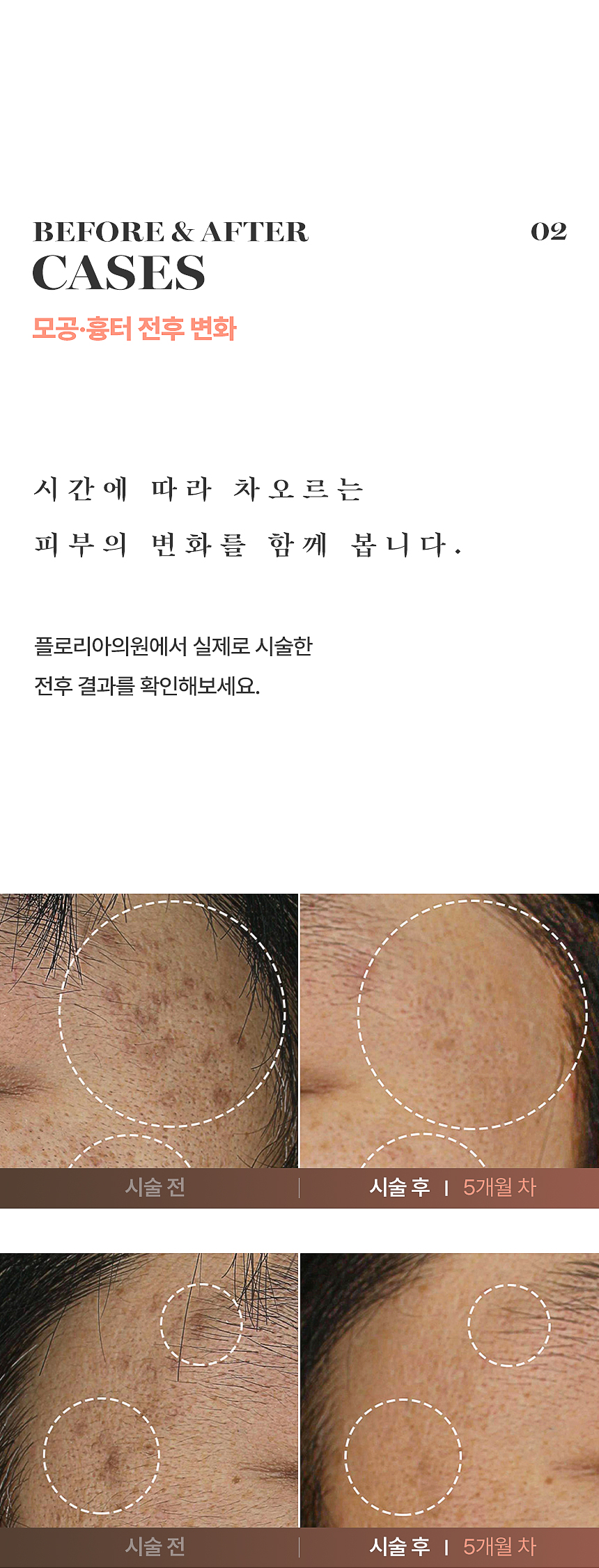 플로리아 모공·여드름 흉터 치료 전후 사례