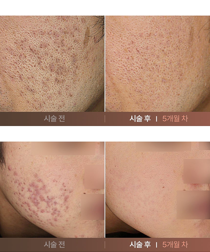 패인 여드름 흉터 치료 5개월 전후 변화