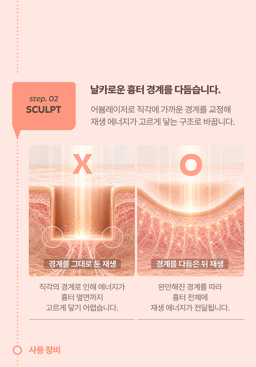 어븀레이저를 이용한 여드름 흉터 경계 교정