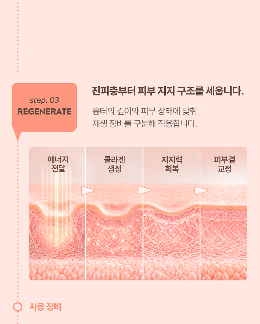 여드름 흉터·모공 진피 재생과 콜라겐 재생 치료