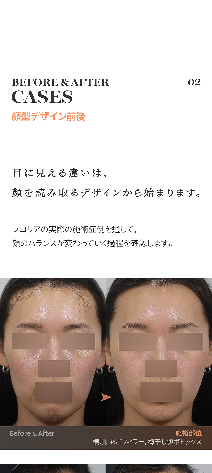 額・こめかみ・あごフィラーとエラボトックス症例