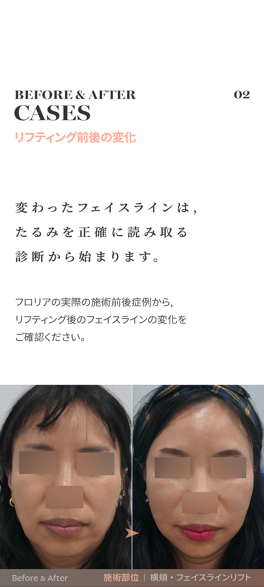 02_ 脂肪層 & 下顔面の変化