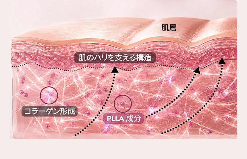 スカルプトラ コラーゲン形成と自然なボリューム