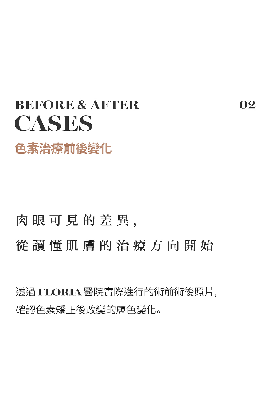 雀斑·褐色色素雷射治療