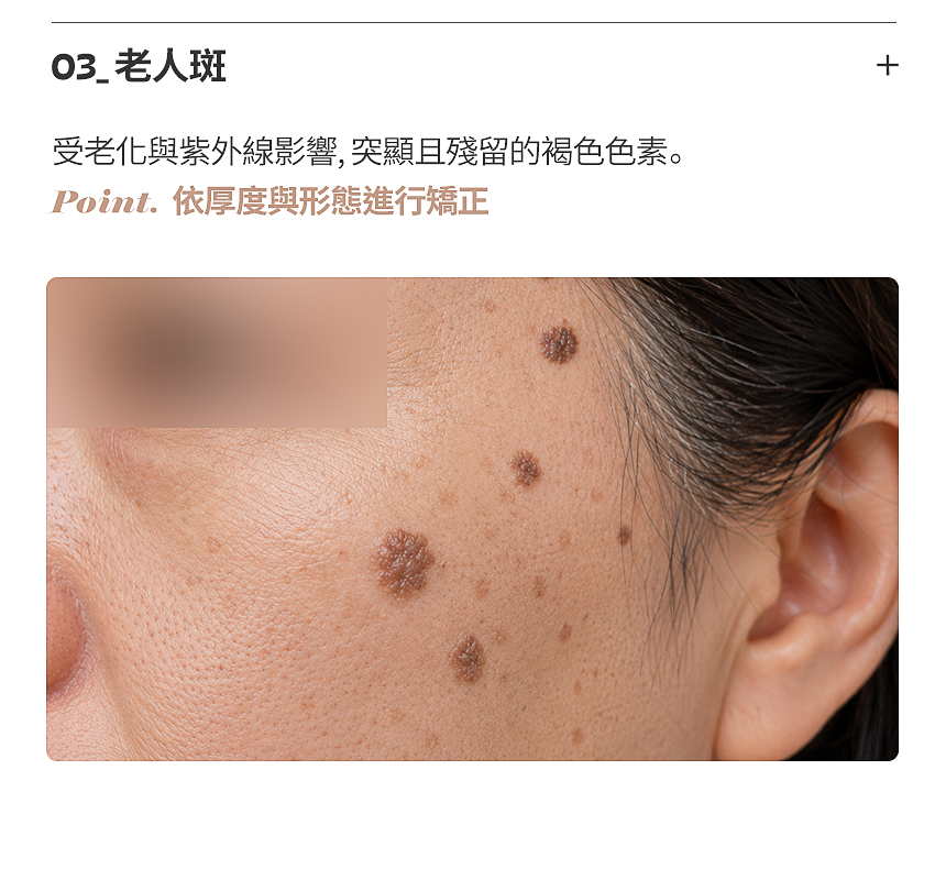 表皮性色素·真皮性色素客製化雷射治療
