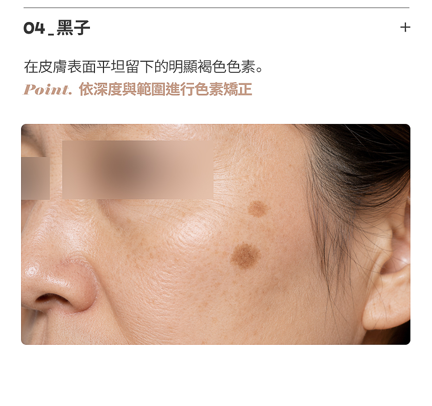 肝斑·黑子複合色素治療