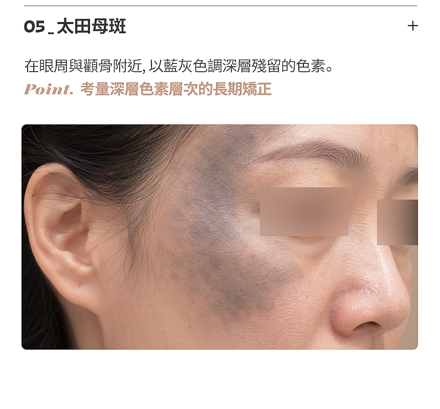 考量肝斑肌膚刺激的客製化雷射治療