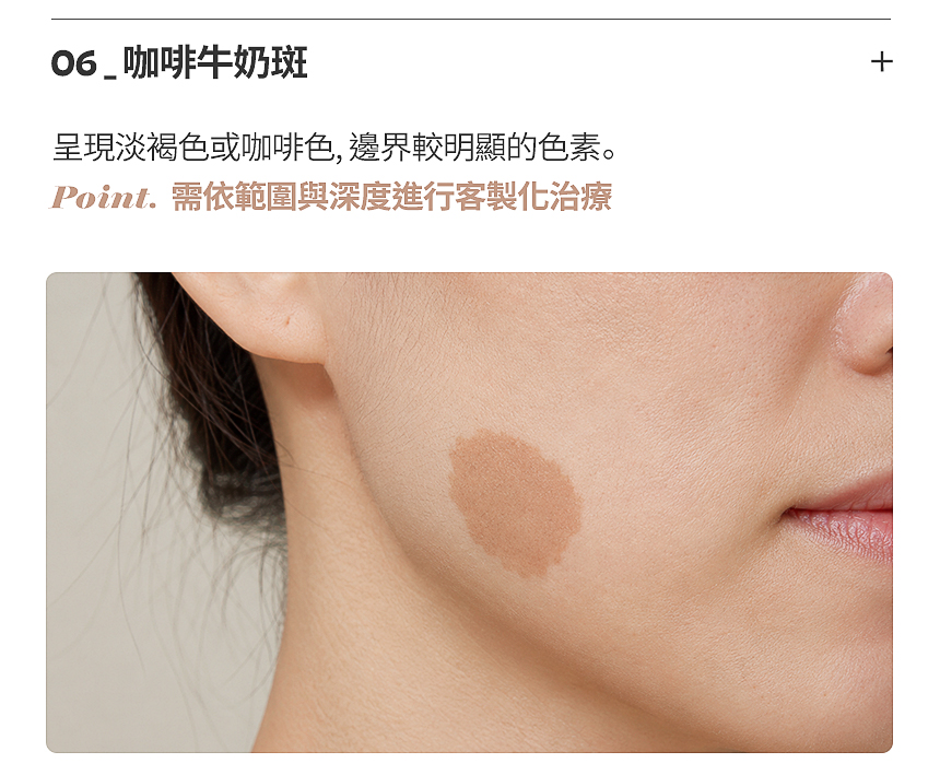 黑子·雀斑色素雷射治療