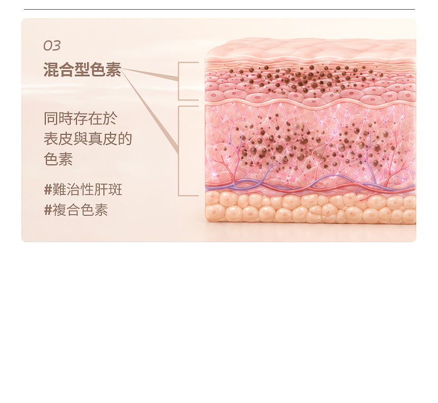 肝斑·黑子·雀斑複合色素客製化治療