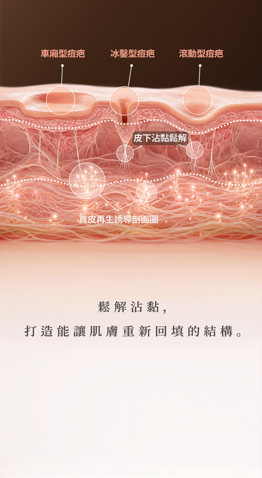 痘疤凹陷與皮下沾黏改善治療