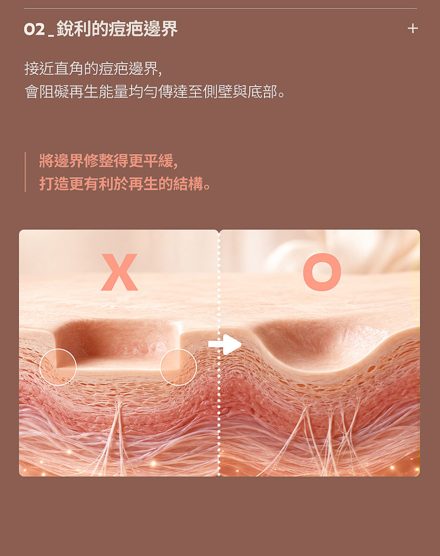 痘疤銳利邊界修整與真皮再生