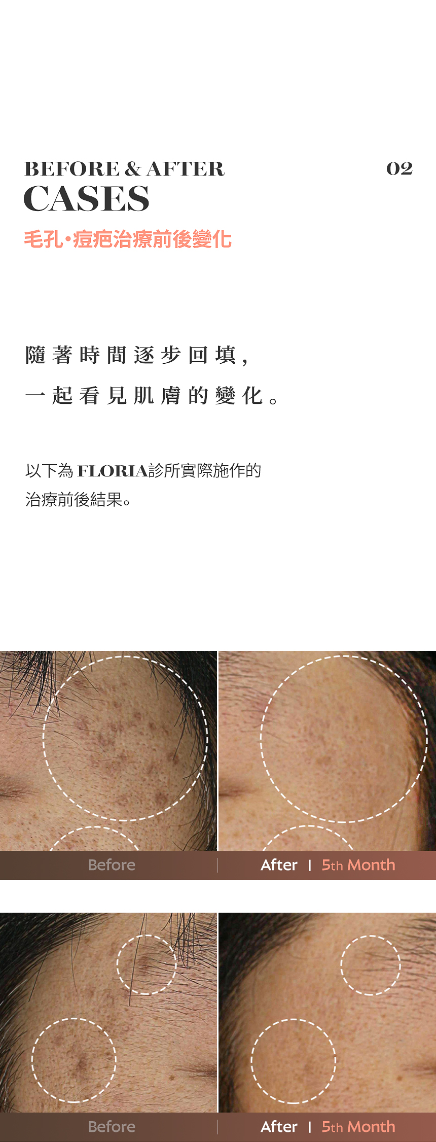 FLORIA 毛孔・痘疤治療前後案例