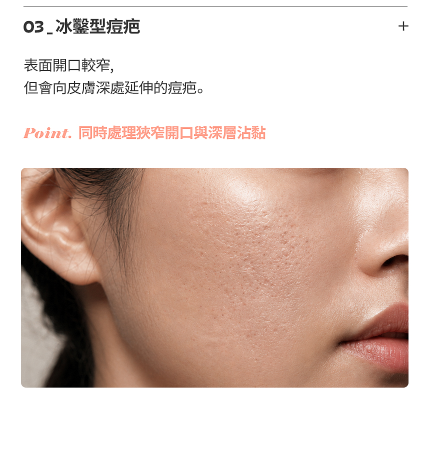 箱型痘疤邊界與凹陷治療