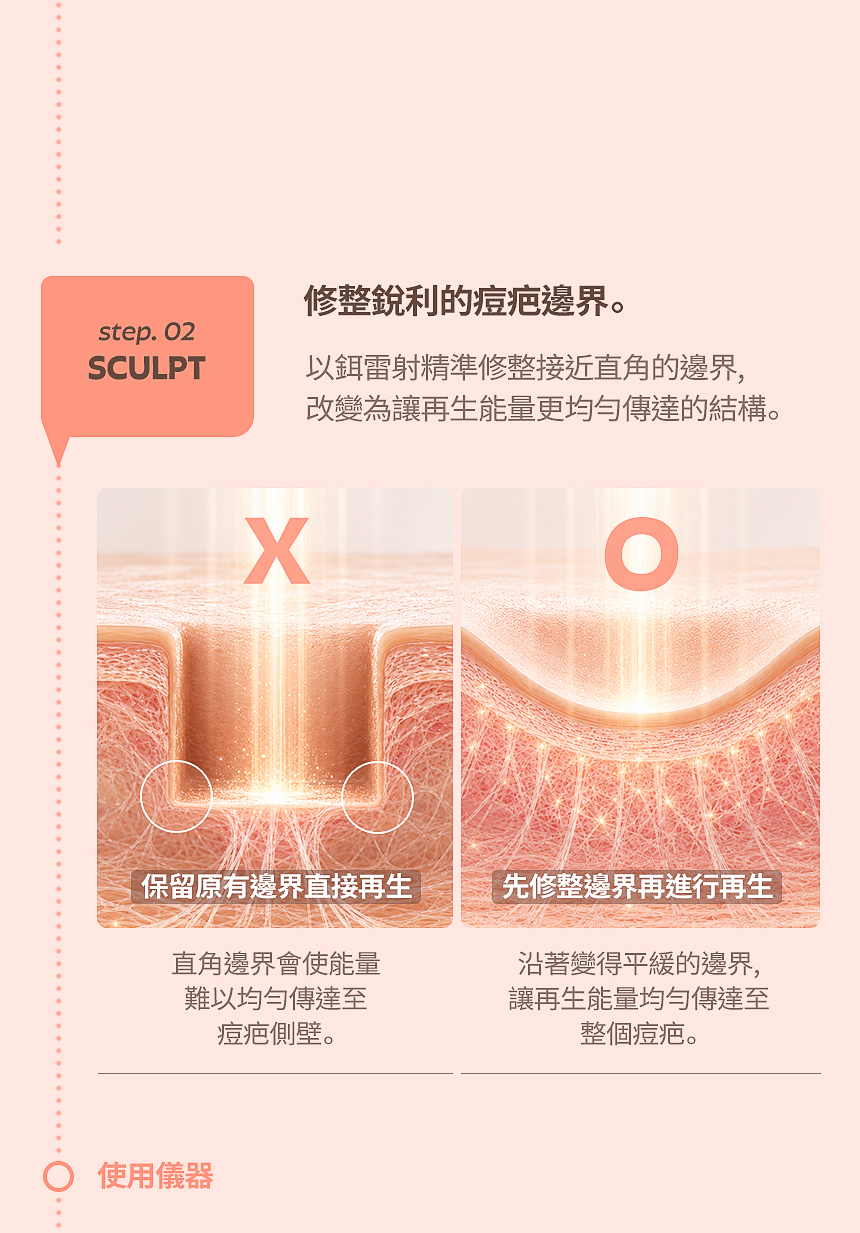 痘疤銳利邊界精細修整治療