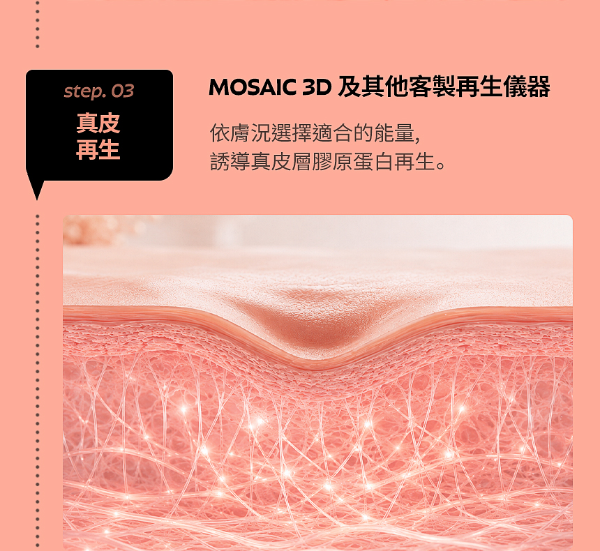 MOSAIC 3D 痘疤・毛孔真皮再生治療