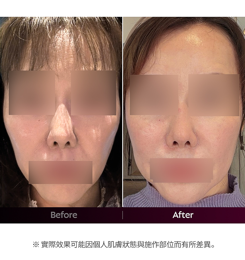 舒顏萃 PLLA 成分 肌膚深層注入