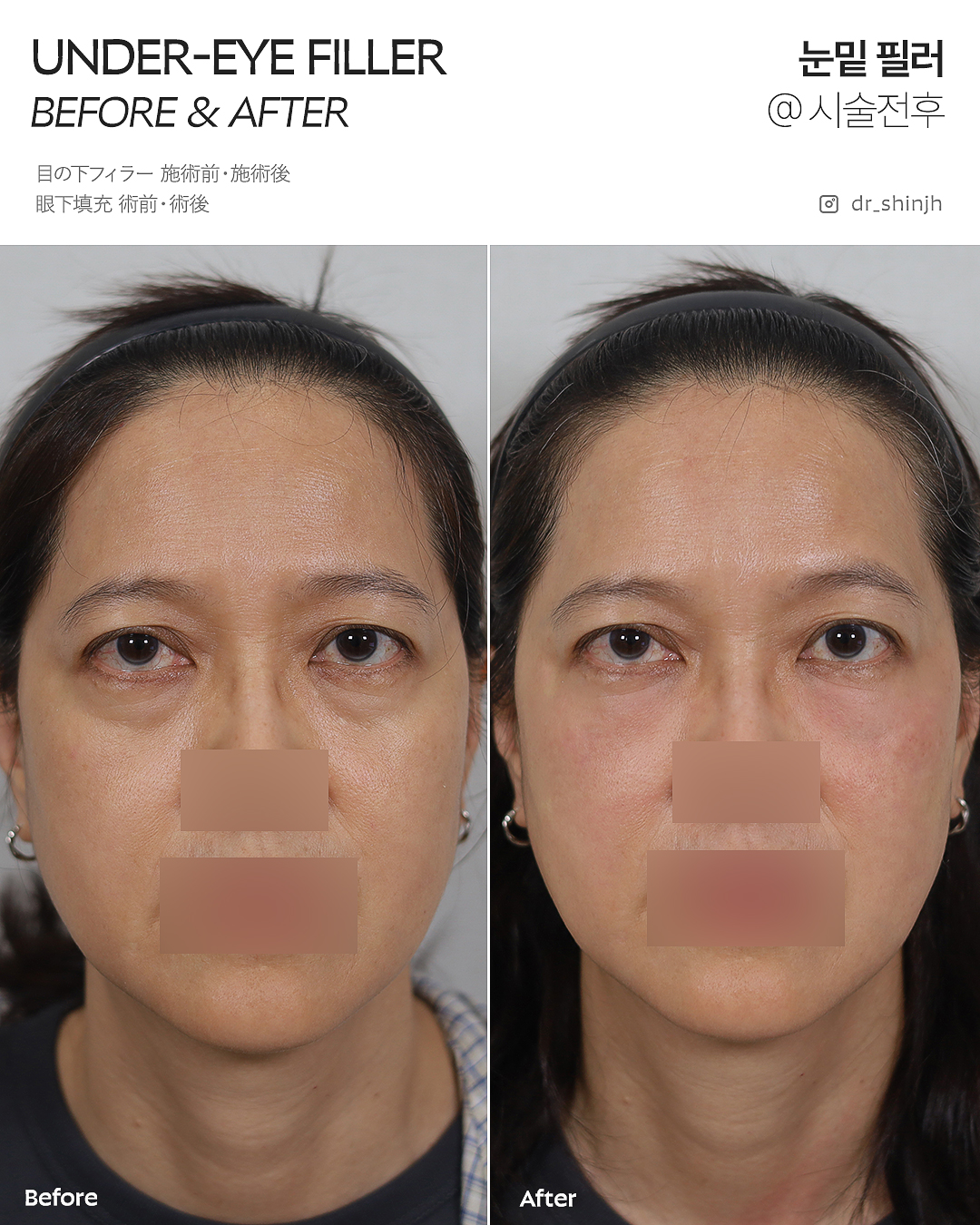 FLORIA Clinic 术前术后照片