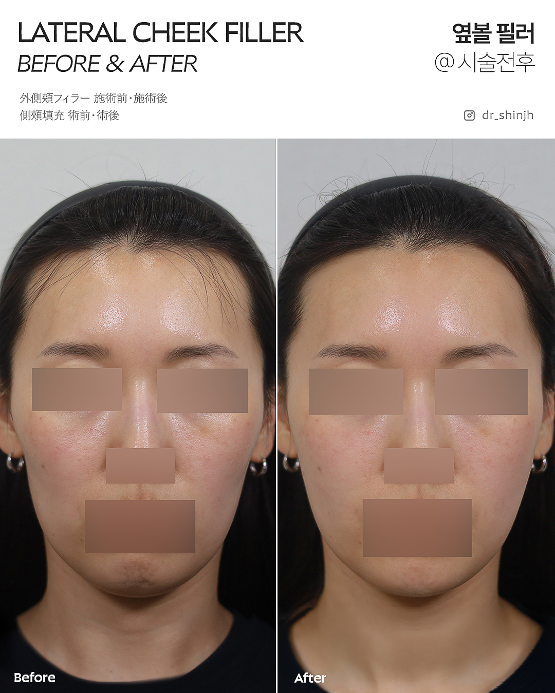 FLORIA Clinic 术前术后照片