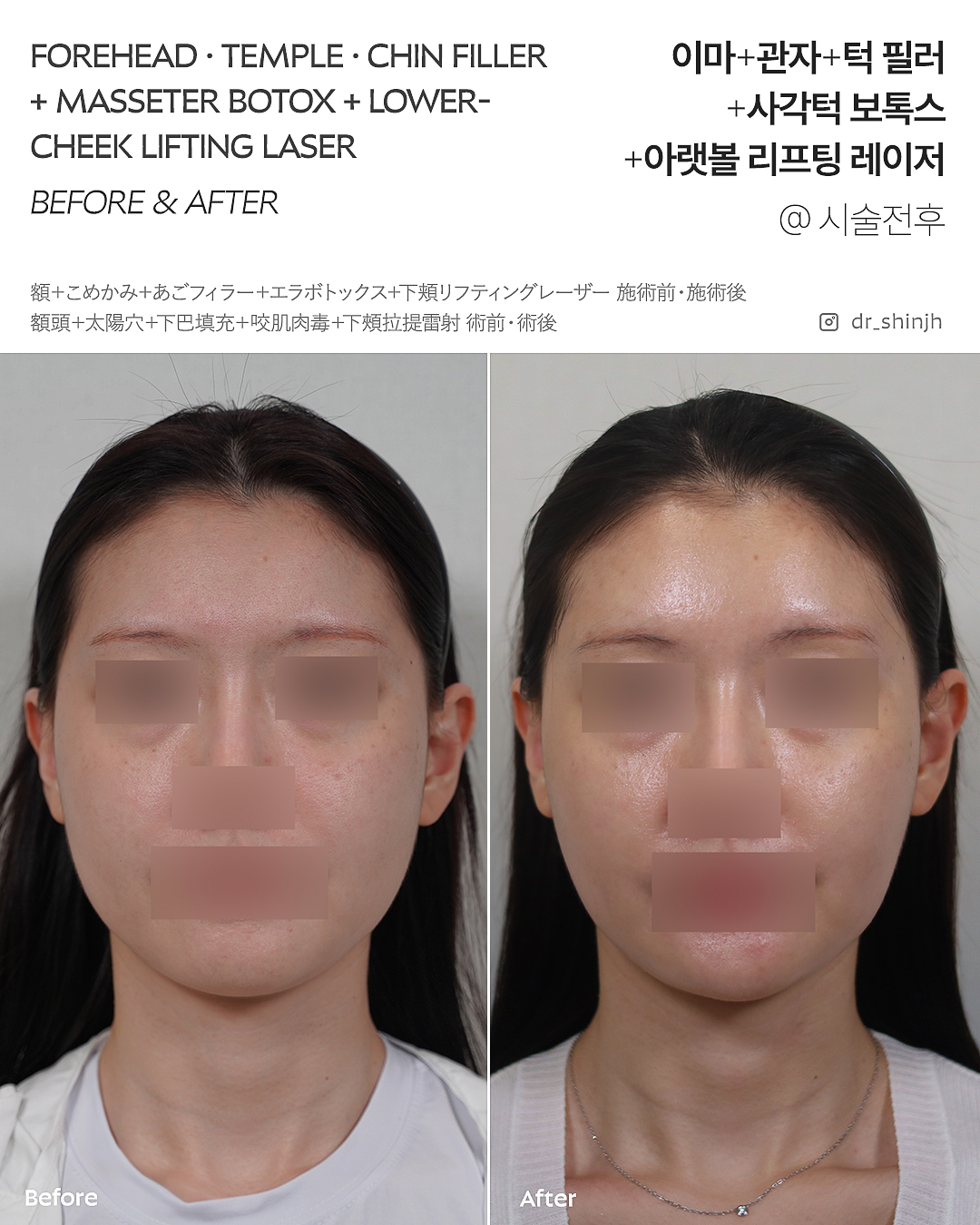 FLORIA Clinic 术前术后照片